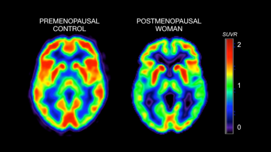 Women Have Unbelievable Brain Changes After Menopause: Study