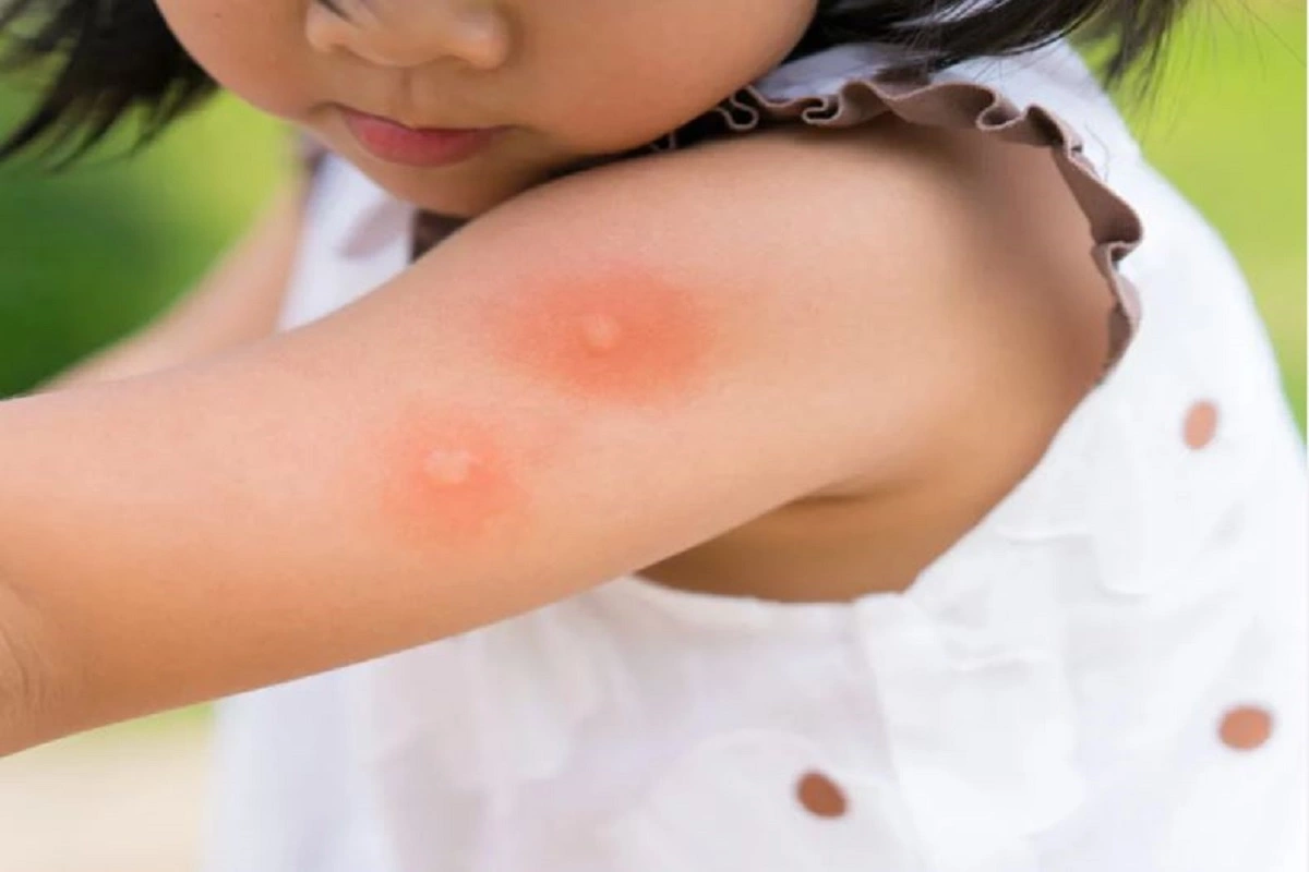 What Parents Need To Know As Dengue Infection In Children Is On The Rise
