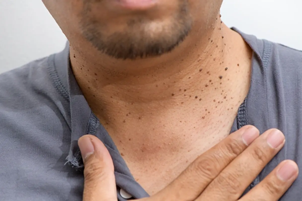 What Are Warts? Why You Should Not Ignore This Skin Problem 