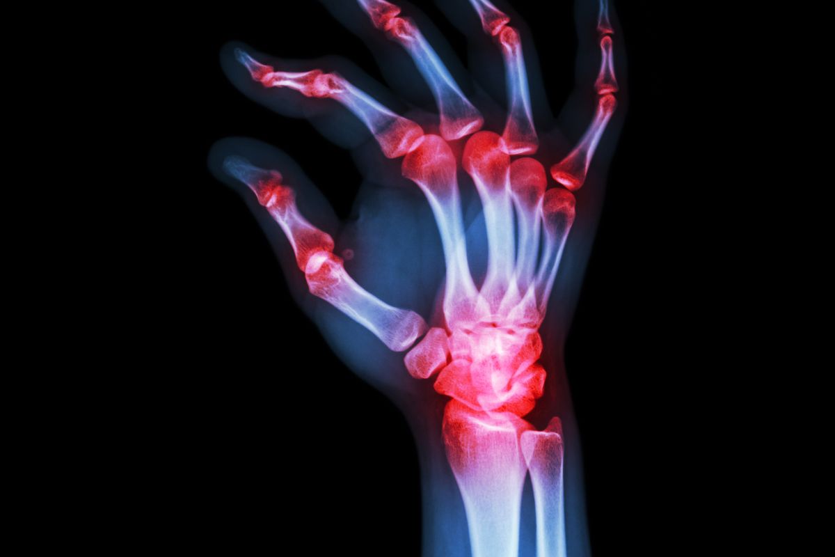 Navigating Psoriatic Arthritis: A Comprehensive Guide