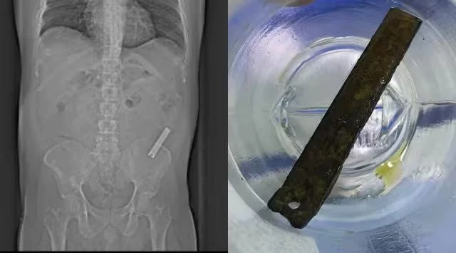 This Man literally Forgot About a Swallowed Nailcutter; Finally Got It Removed After 8 Years