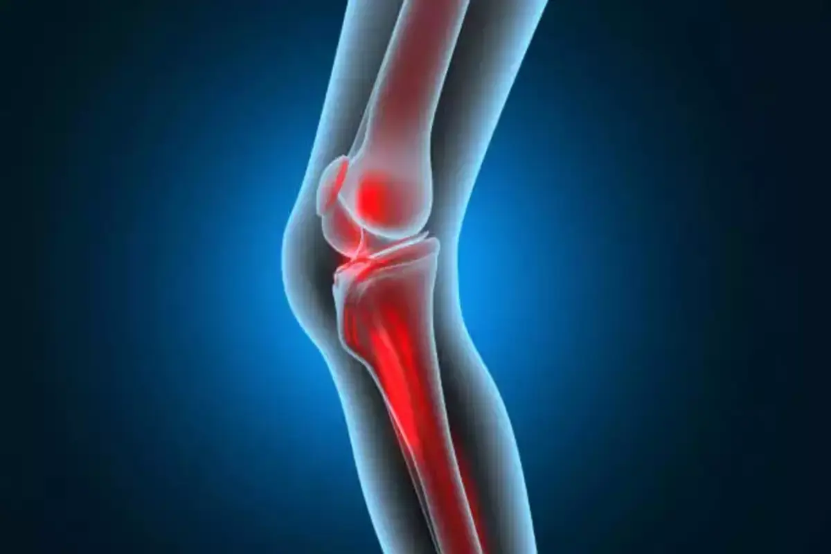 Lancet Study: One Billion People Globally To Have Osteoarthritis By 2050