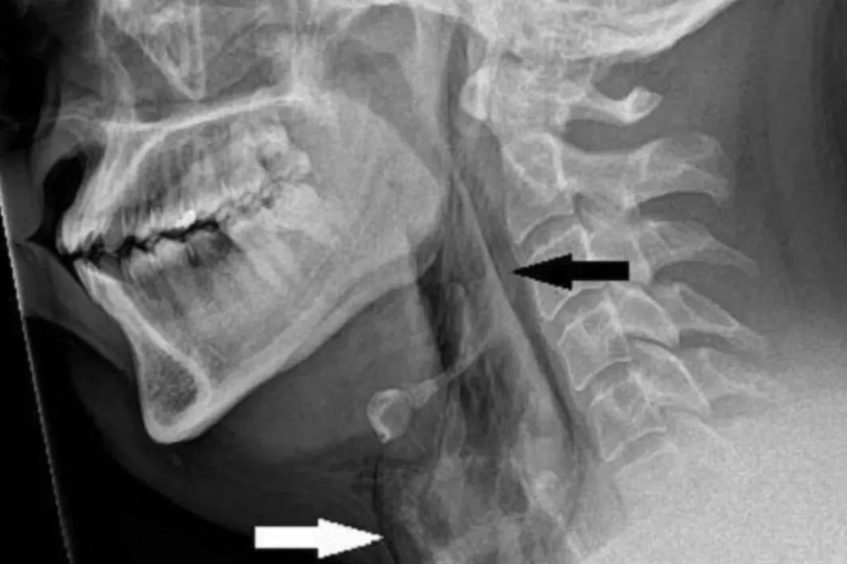 First Time Ever In Medical Science: Windpipe Of Man Bursts In An Effort To Hold Sneeze