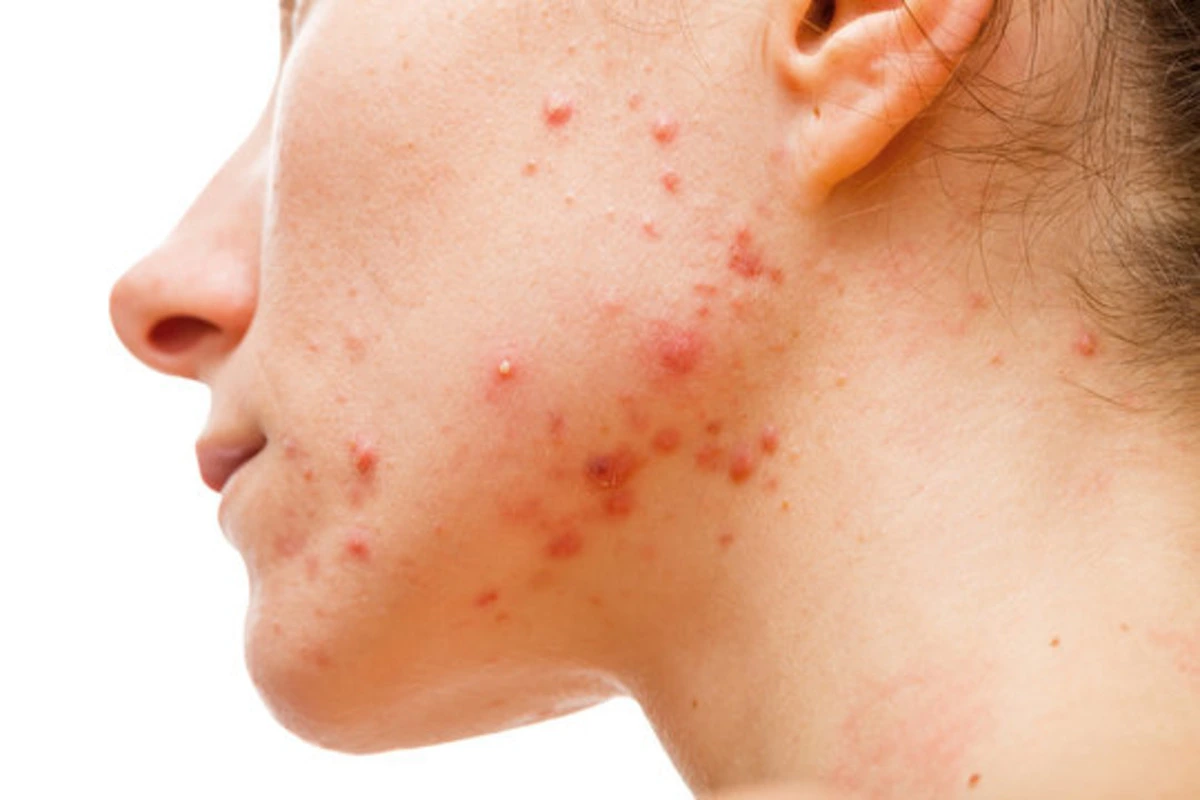 5 Tips For Achieving Pimple-Free Skin