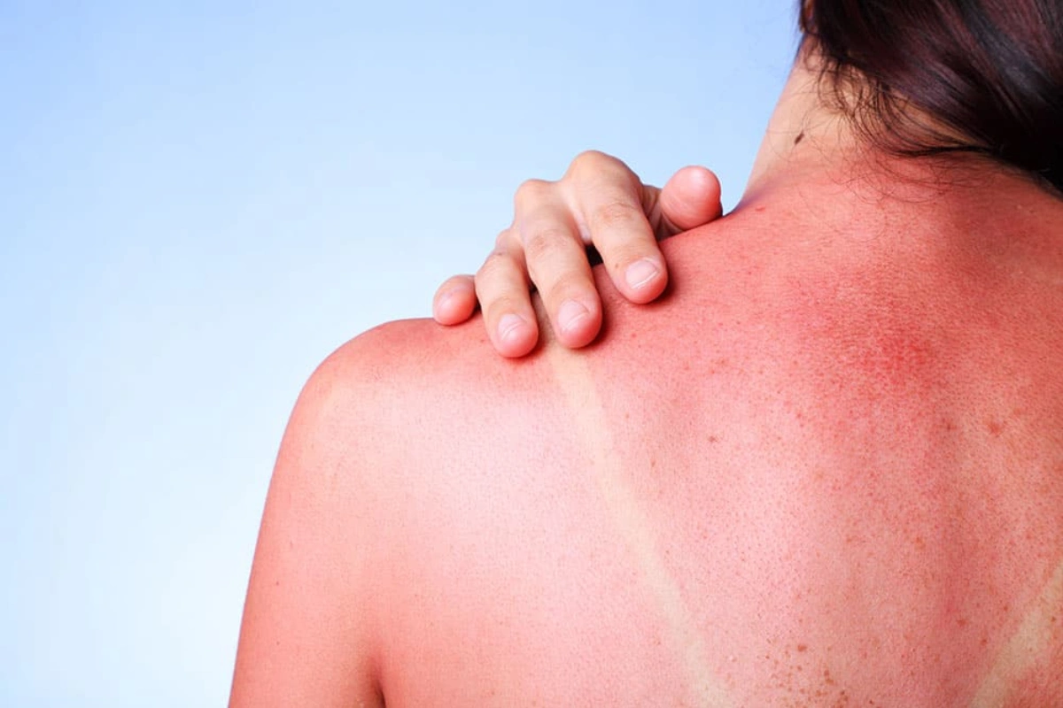 Quick Relief For Sunburn: What You Can Do Immediately