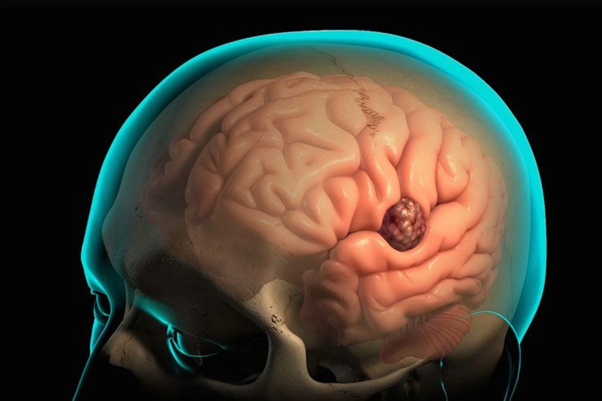 Study Finds Glioblastoma Alters Skull And Immune Response