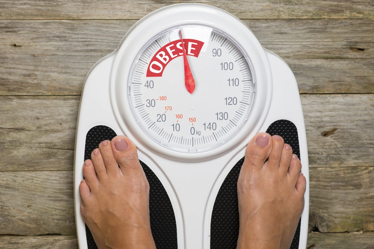Obesity Linked To Alzheimer’s Risk In Adults With Down Syndrome, Study Finds